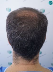 Injerto Capilar Técnica FUE 6557 Grafts (14215 Pelos) 30 36 EN 12 MESES