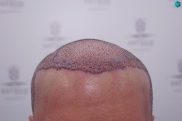 Injerto Capilar Técnica FUE Grafts 3223 (9295 Pelos) 29 RETOQUE INJERTO CAPILAR