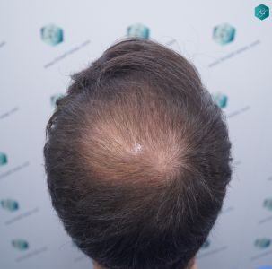 Injerto Capilar Técnica FUE 6557 Grafts (14215 Pelos) 31 37 EN 12 MESES