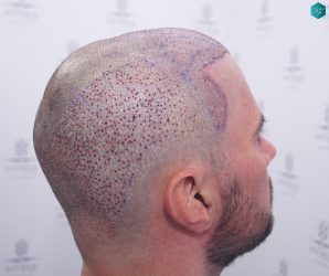 Injerto Capilar Técnica FUE Grafts 3223 (9295 Pelos) 30 RETOQUE INJERTO CAPILAR