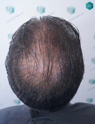 SEGUNDA INTERVENCIÓN SEGUNDA INTERVENCIÓN