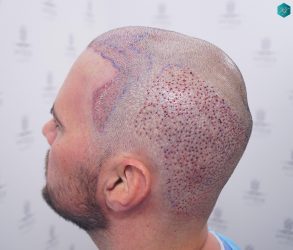 Injerto Capilar Técnica FUE Grafts 3223 (9295 Pelos) 31 RETOQUE INJERTO CAPILAR