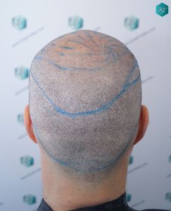 Injerto Capilar Técnica FUE 6557 Grafts (14215 Pelos) 32 39 CORONILLA