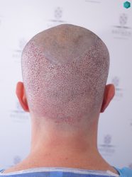 Injerto Capilar Técnica FUE Grafts 3223 (9295 Pelos) 32 RETOQUE INJERTO CAPILAR