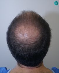 Injerto Capilar Técnica FUE 6557 Grafts (14215 Pelos) 3 4 ANTES 1