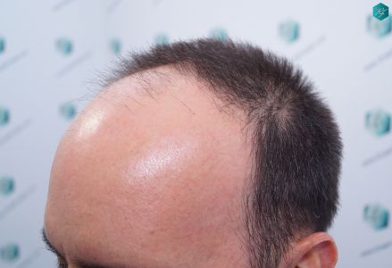 Injerto Capilar Técnica FUE Grafts 3223 (9295 Pelos) 4 ANTES DEL TRASPLANTE CAPILAR