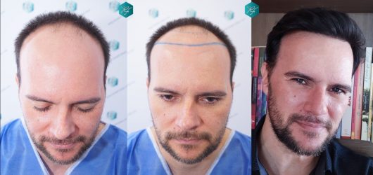 COMPARATIVA INJERTO CAPILAR ANTES Y DESPUÉS COMPARATIVA INJERTO CAPILAR ANTES Y DESPUÉS