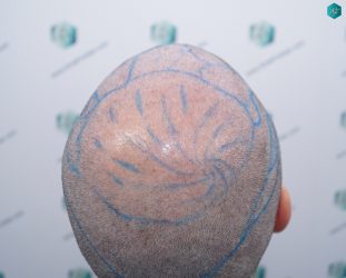 Injerto Capilar Técnica FUE 6557 Grafts (14215 Pelos) 33 40 CORONILLA
