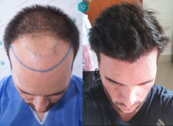 Injerto Capilar Técnica FUE Grafts 3223 (9295 Pelos) 33 COMPARATIVA INJERTO CAPILAR ANTES Y DESPUÉS