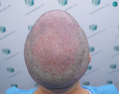 Injerto Capilar Técnica FUE 6557 Grafts (14215 Pelos) 34 41 TRASPLANTE