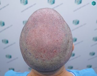 Injerto Capilar Técnica FUE 6557 Grafts (14215 Pelos) 34 41 TRASPLANTE