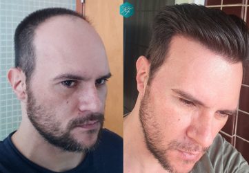 Injerto Capilar Técnica FUE Grafts 3223 (9295 Pelos) 34 COMPARATIVA INJERTO CAPILAR ANTES Y DESPUÉS