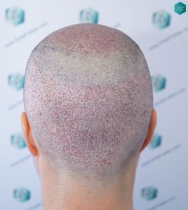 Injerto Capilar Técnica FUE 6557 Grafts (14215 Pelos) 35 42 CORONILLA