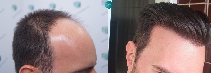 Injerto Capilar Técnica FUE Grafts 3223 (9295 Pelos) 35 COMPARATIVA INJERTO CAPILAR ANTES Y DESPUÉS