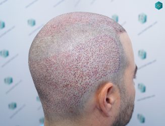 Injerto Capilar Técnica FUE 6557 Grafts (14215 Pelos) 36 43 CORONILLA
