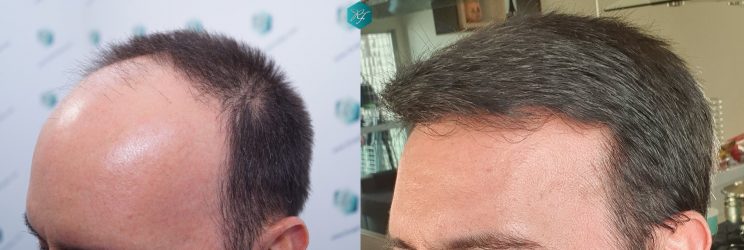 Injerto Capilar Técnica FUE Grafts 3223 (9295 Pelos) 36 COMPARATIVA INJERTO CAPILAR ANTES Y DESPUÉS