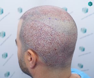 Injerto Capilar Técnica FUE 6557 Grafts (14215 Pelos) 37 44 CORONILLA