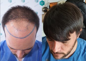 Injerto Capilar Técnica FUE Grafts 3223 (9295 Pelos) 37 COMPARATIVA INJERTO CAPILAR ANTES Y DESPUÉS