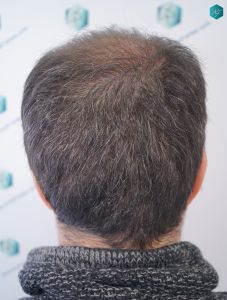 Injerto Capilar Técnica FUE 6557 Grafts (14215 Pelos) 38 45 EN 3 MESES