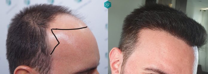 Injerto Capilar Técnica FUE Grafts 3223 (9295 Pelos) 38 COMPARATIVA INJERTO CAPILAR ANTES Y DESPUÉS