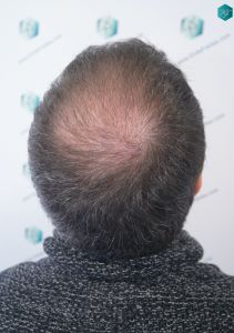 Injerto Capilar Técnica FUE 6557 Grafts (14215 Pelos) 39 46 EN 3 MESES
