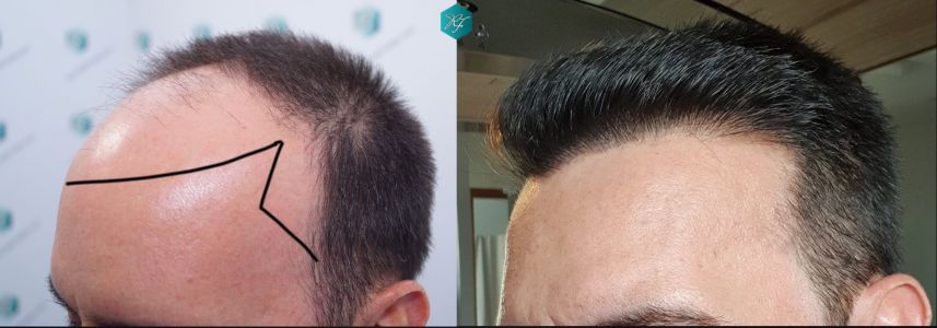 Injerto Capilar Técnica FUE Grafts 3223 (9295 Pelos) 39 COMPARATIVA INJERTO CAPILAR ANTES Y DESPUÉS