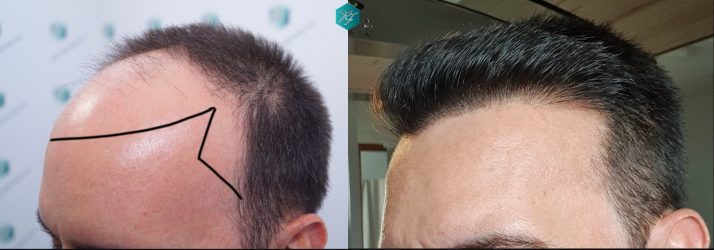 Injerto Capilar Técnica FUE Grafts 3223 (9295 Pelos) 39 COMPARATIVA INJERTO CAPILAR ANTES Y DESPUÉS