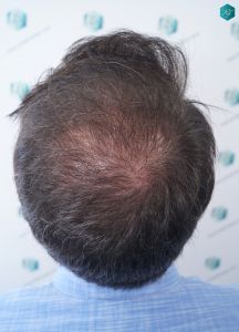 Injerto Capilar Técnica FUE 6557 Grafts (14215 Pelos) 40 47 EN 6 MESES