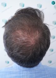 Injerto Capilar Técnica FUE 6557 Grafts (14215 Pelos) 39 47 EN 6 MESES