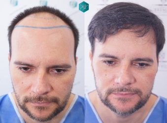 Injerto Capilar Técnica FUE Grafts 3223 (9295 Pelos) 40 COMPARATIVA INJERTO CAPILAR ANTES Y DESPUÉS
