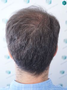 Injerto Capilar Técnica FUE 6557 Grafts (14215 Pelos) 41 48 EN 6 MESES