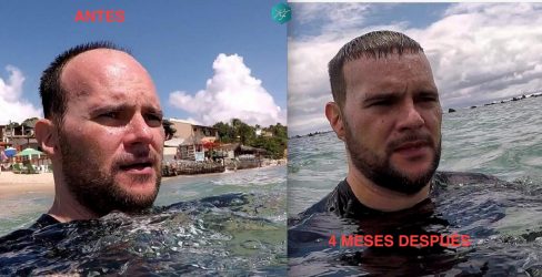 Injerto Capilar Técnica FUE Grafts 3223 (9295 Pelos) 41 COMPARATIVA INJERTO CAPILAR ANTES Y DESPUÉS