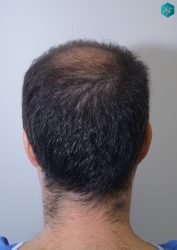 Injerto Capilar Técnica FUE 6557 Grafts (14215 Pelos) 4 5 ANTES 1