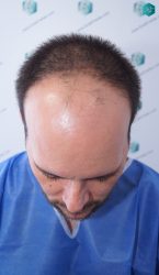 Injerto Capilar Técnica FUE Grafts 3223 (9295 Pelos) 5 ANTES DEL TRASPLANTE CAPILAR