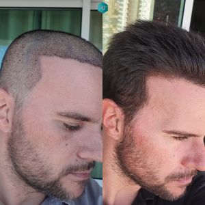 Injerto Capilar Técnica FUE Grafts 3223 (9295 Pelos) 42 COMPARATIVA INJERTO CAPILAR ANTES Y DESPUÉS