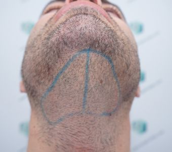 Injerto Capilar Técnica FUE 6557 Grafts (14215 Pelos) 42 50 RETOQUE BHT