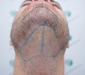 Injerto Capilar Técnica FUE 6557 Grafts (14215 Pelos) 41 50 RETOQUE BHT