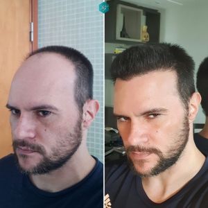 Injerto Capilar Técnica FUE Grafts 3223 (9295 Pelos) 43 COMPARATIVA INJERTO CAPILAR ANTES Y DESPUÉS