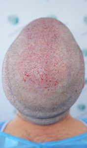 Injerto Capilar Técnica FUE 6557 Grafts (14215 Pelos) 43 51 RETOQUE BHT