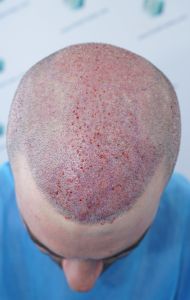 Injerto Capilar Técnica FUE 6557 Grafts (14215 Pelos) 44 52 RETOQUE BHT