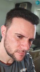 Injerto Capilar Técnica FUE Grafts 3223 (9295 Pelos) 42 RESULTADOS EN 12 MESES