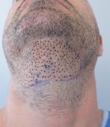 Injerto Capilar Técnica FUE 6557 Grafts (14215 Pelos) 43 53 RETOQUE BHT