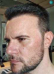 Injerto Capilar Técnica FUE Grafts 3223 (9295 Pelos) 43 RESULTADOS EN 12 MESES