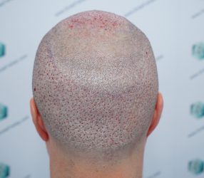 Injerto Capilar Técnica FUE 6557 Grafts (14215 Pelos) 44 54 RETOQUE BHT