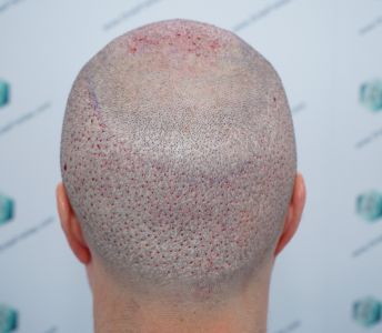 Injerto Capilar Técnica FUE 6557 Grafts (14215 Pelos) 46 54 RETOQUE BHT