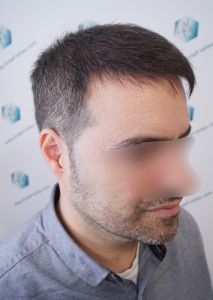 Injerto Capilar Técnica FUE 6557 Grafts (14215 Pelos) 47 55 EN 3 MESES