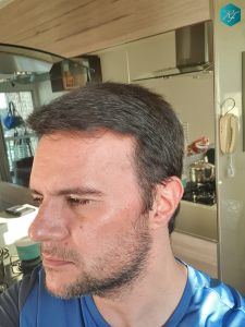 Injerto Capilar Técnica FUE Grafts 3223 (9295 Pelos) 47 RESULTADOS EN 12 MESES