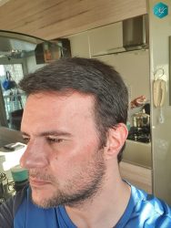 Injerto Capilar Técnica FUE Grafts 3223 (9295 Pelos) 44 RESULTADOS EN 12 MESES