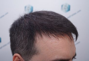 Injerto Capilar Técnica FUE 6557 Grafts (14215 Pelos) 46 56 EN 3 MESES