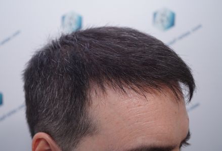 Injerto Capilar Técnica FUE 6557 Grafts (14215 Pelos) 48 56 EN 3 MESES